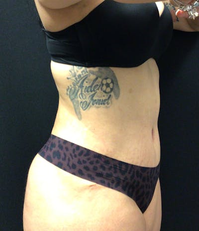 Tummy Tuck Before & After Gallery - Patient 58242838 - Image 4