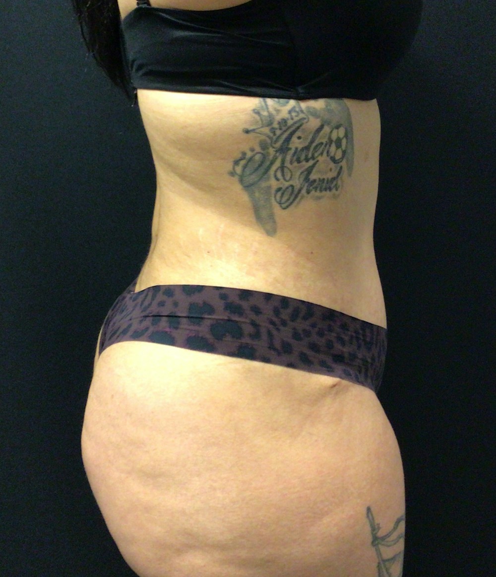 Tummy Tuck Before & After Gallery - Patient 58242838 - Image 6