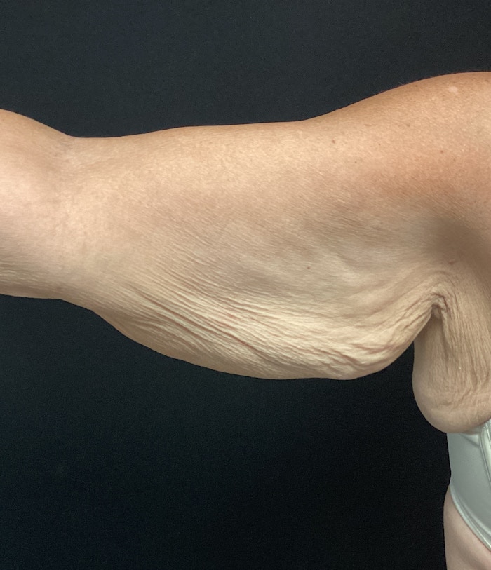 Arm Lift Before & After Gallery - Patient 58242910 - Image 1