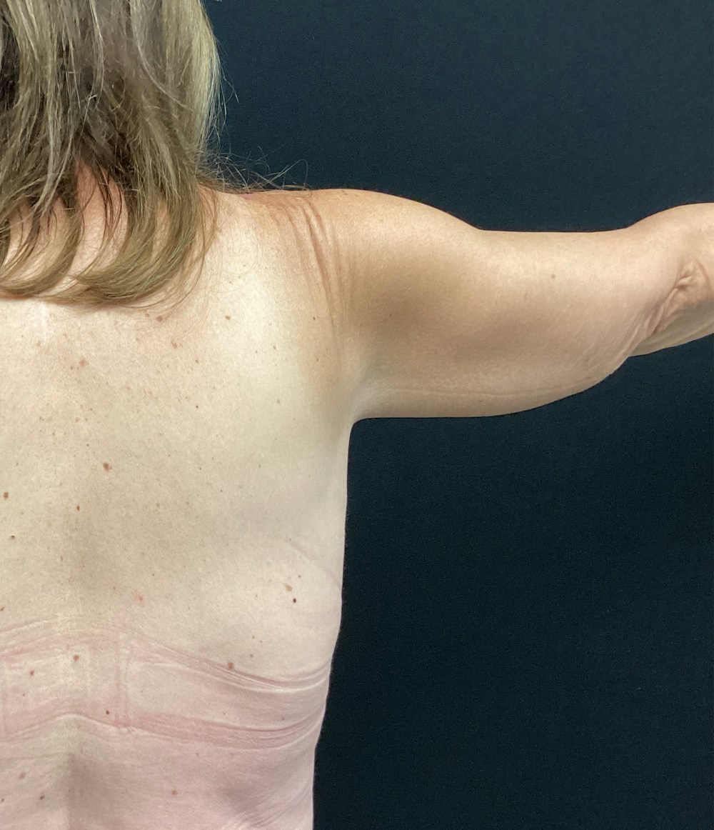 Arm Lift Before & After Gallery - Patient 58242910 - Image 4