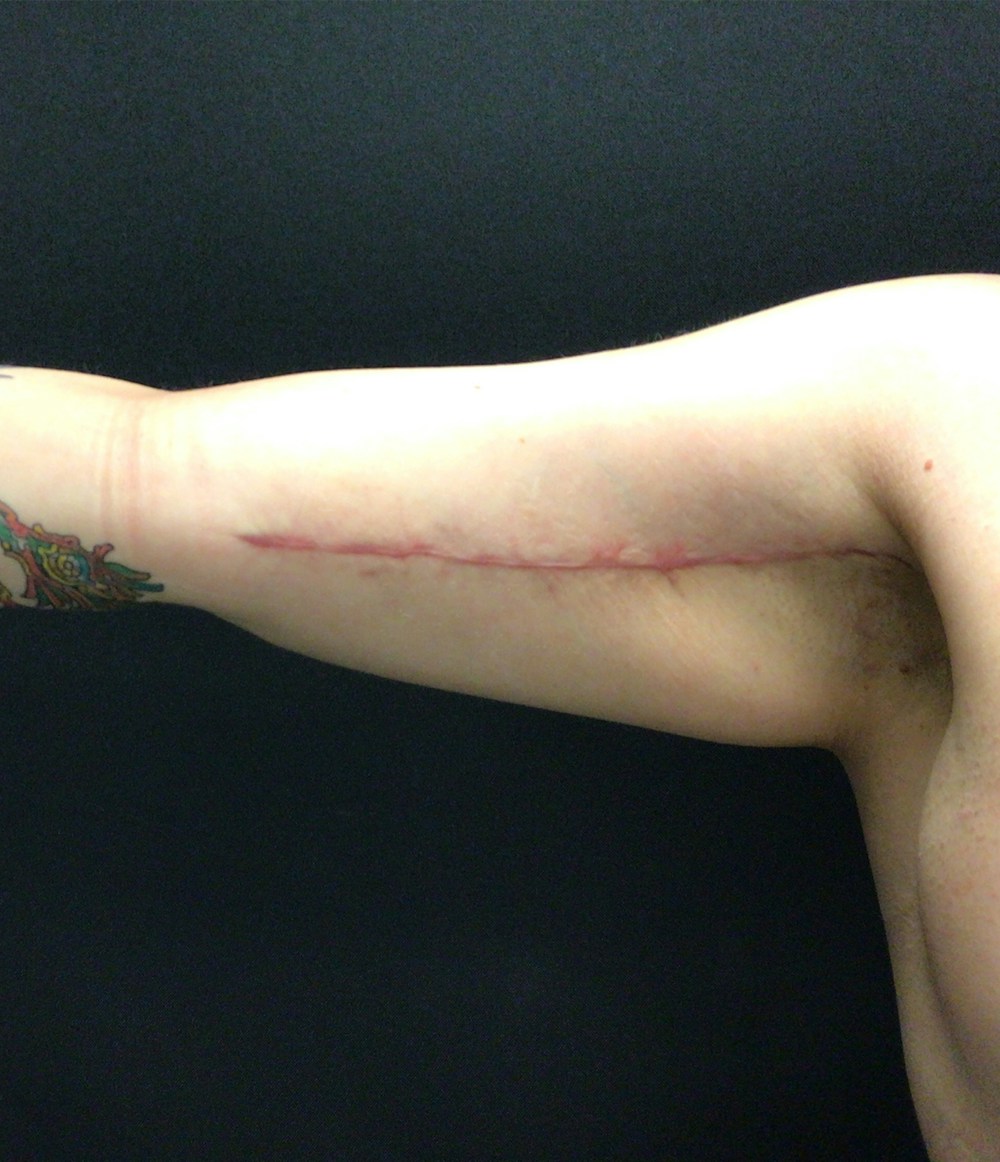 Arm Lift Before & After Gallery - Patient 58242913 - Image 2