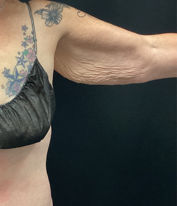 Arm Lift Before & After Gallery - Patient 58242915 - Image 1