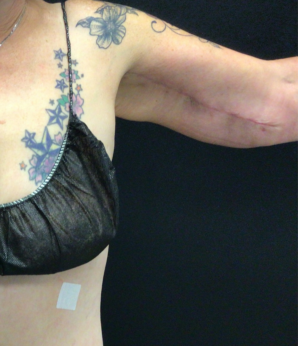 Arm Lift Before & After Gallery - Patient 58242915 - Image 2
