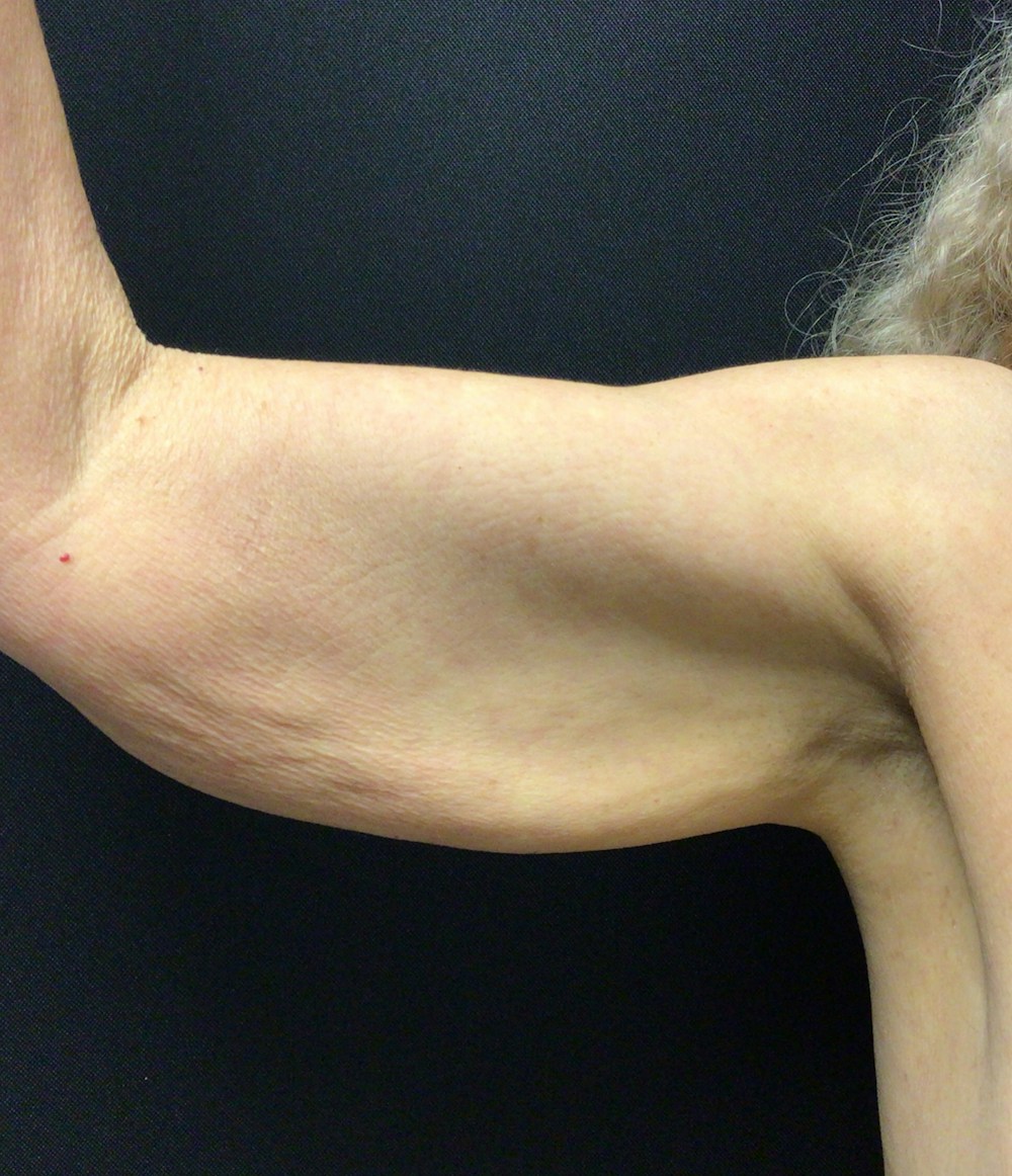 Arm Lift Before & After Gallery - Patient 58243056 - Image 1