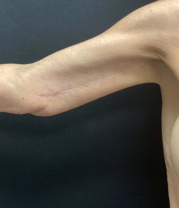 Arm Lift Before & After Gallery - Patient 58243056 - Image 2