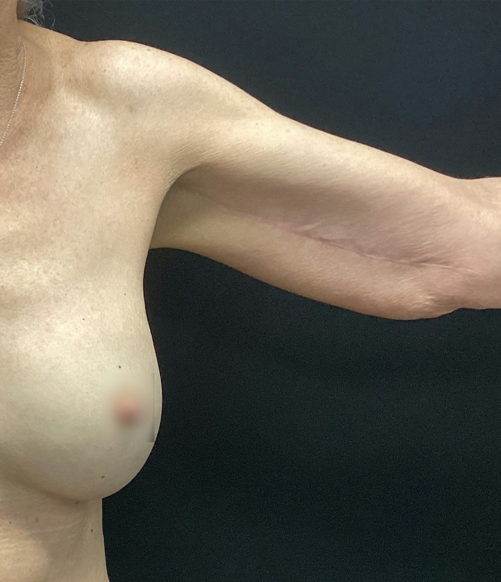 Arm Lift Before & After Gallery - Patient 58243056 - Image 4
