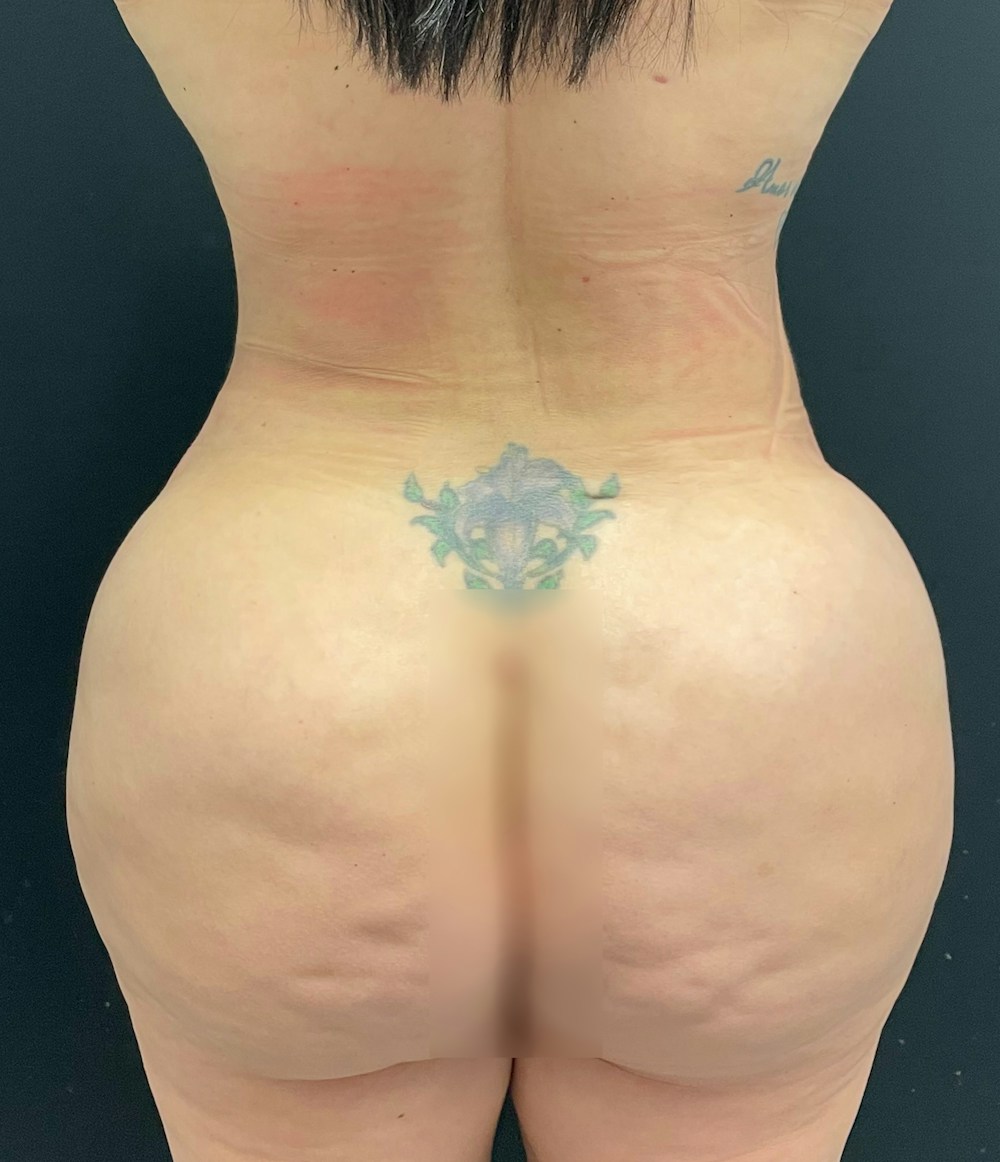 Brazilian Butt Lift Before & After Gallery - Patient 58243743 - Image 2
