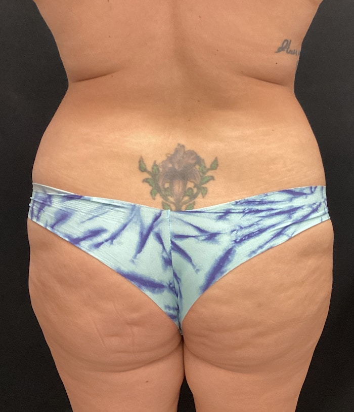 Brazilian Butt Lift Before & After Gallery - Patient 58243743 - Image 1