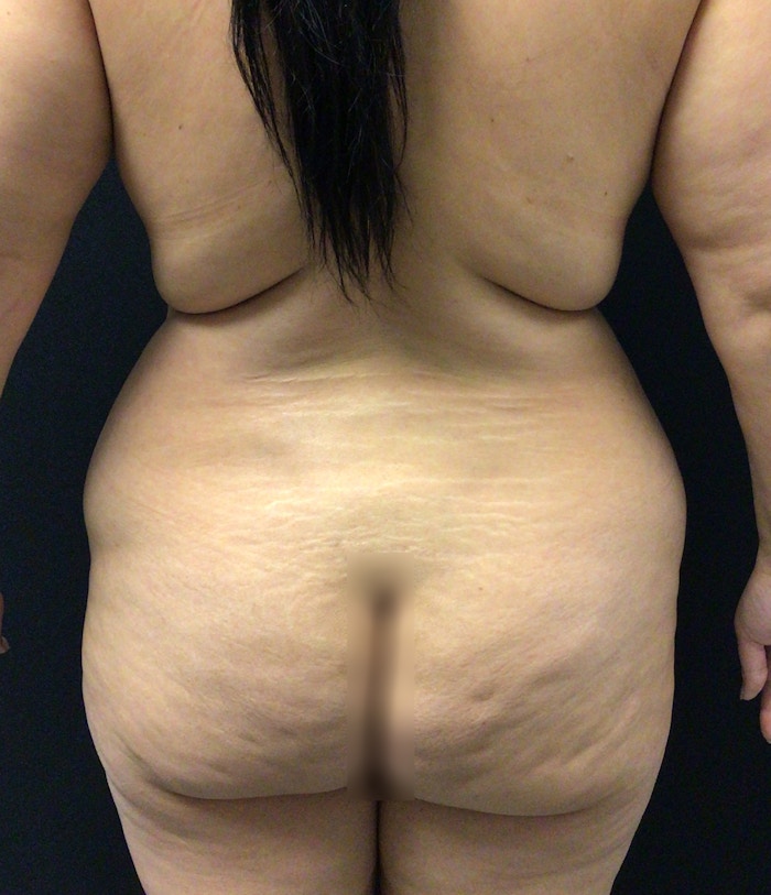 Brazilian Butt Lift Before & After Gallery - Patient 58243813 - Image 1