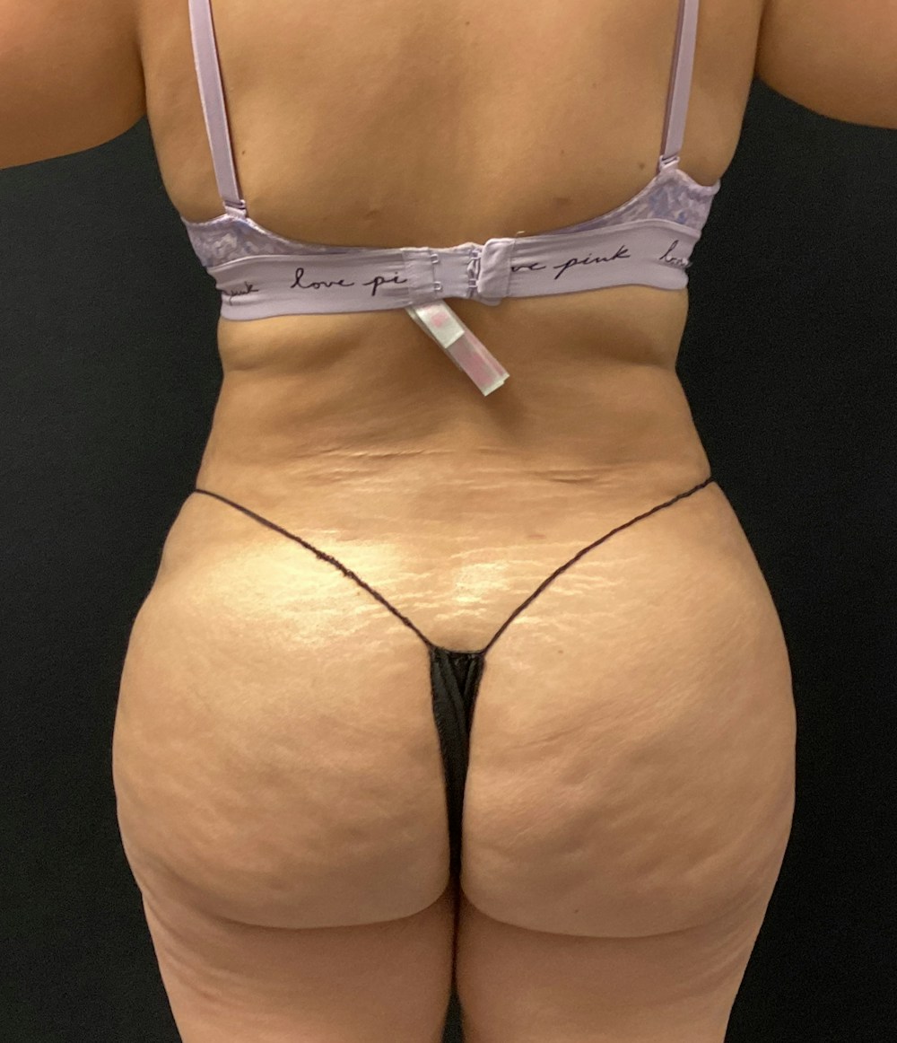 Brazilian Butt Lift Before & After Gallery - Patient 58243813 - Image 2