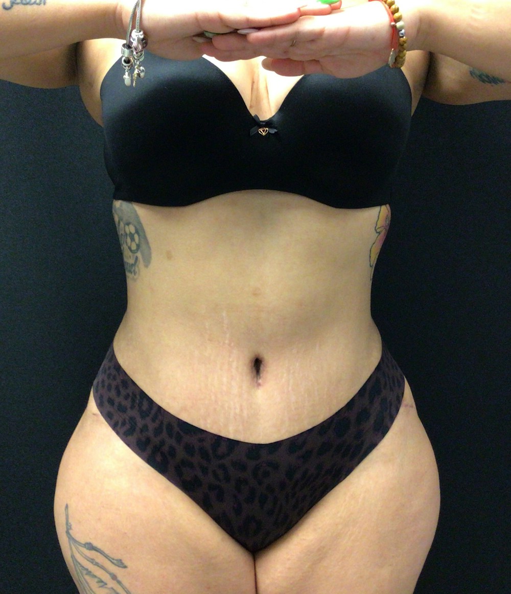 Brazilian Butt Lift Before & After Gallery - Patient 58243818 - Image 4