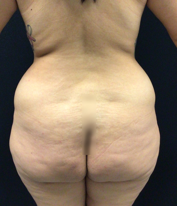 Brazilian Butt Lift Before & After Gallery - Patient 58243818 - Image 1