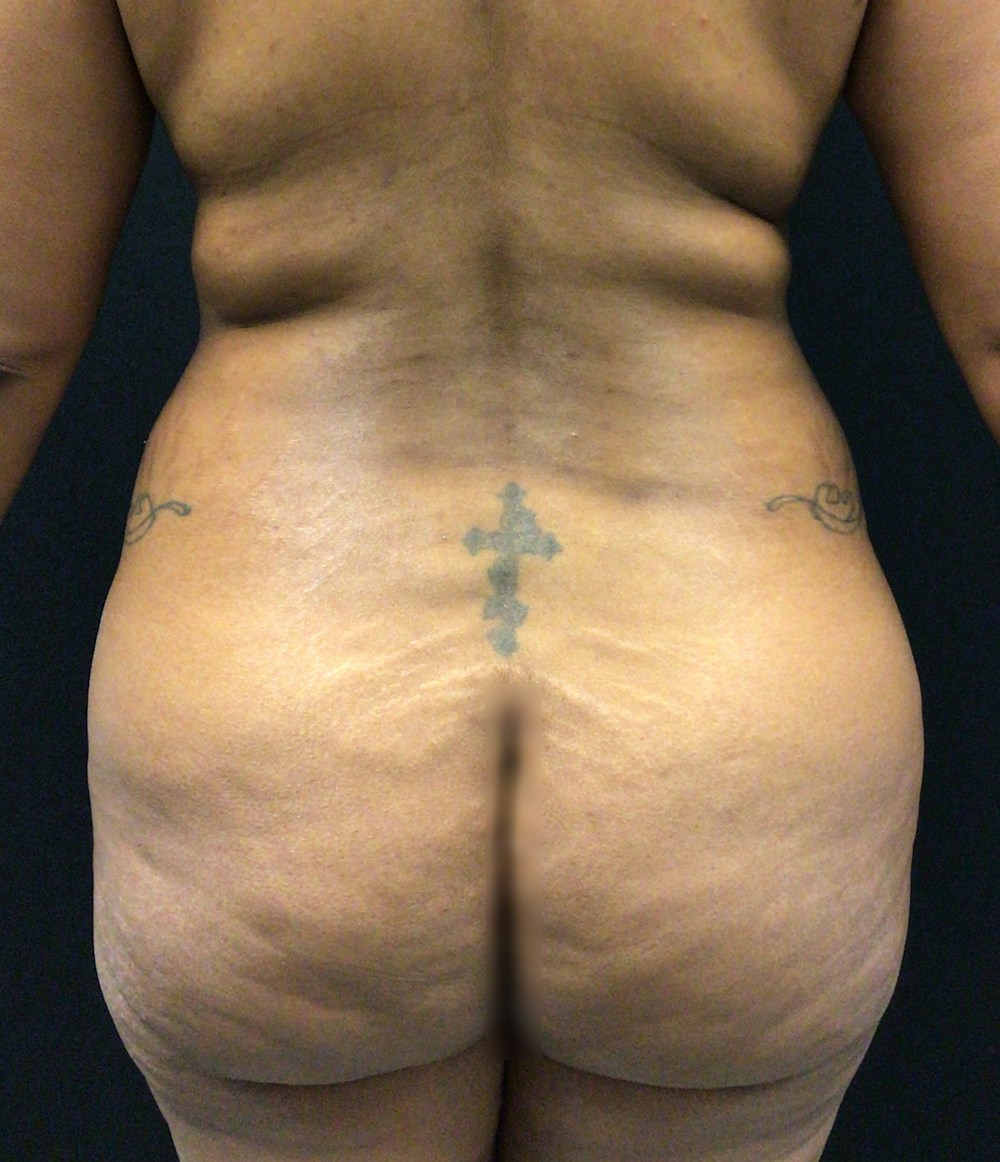 Brazilian Butt Lift Before & After Gallery - Patient 58244184 - Image 1