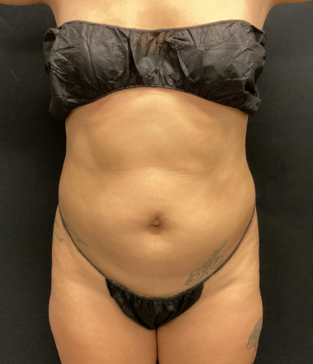 Lipo 360 Before & After Gallery - Patient 89193878 - Image 1
