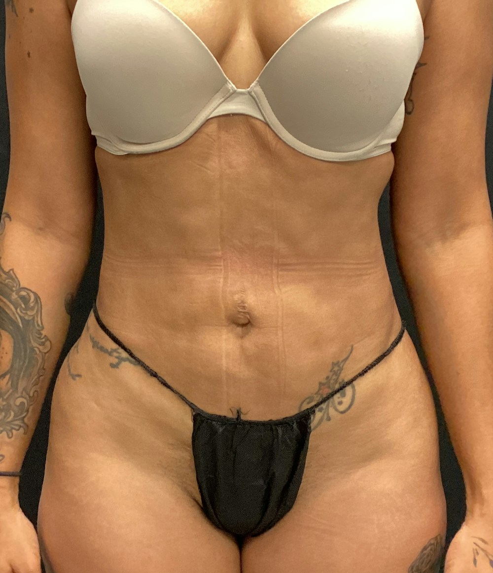 Lipo 360 Before & After Gallery - Patient 89193878 - Image 2