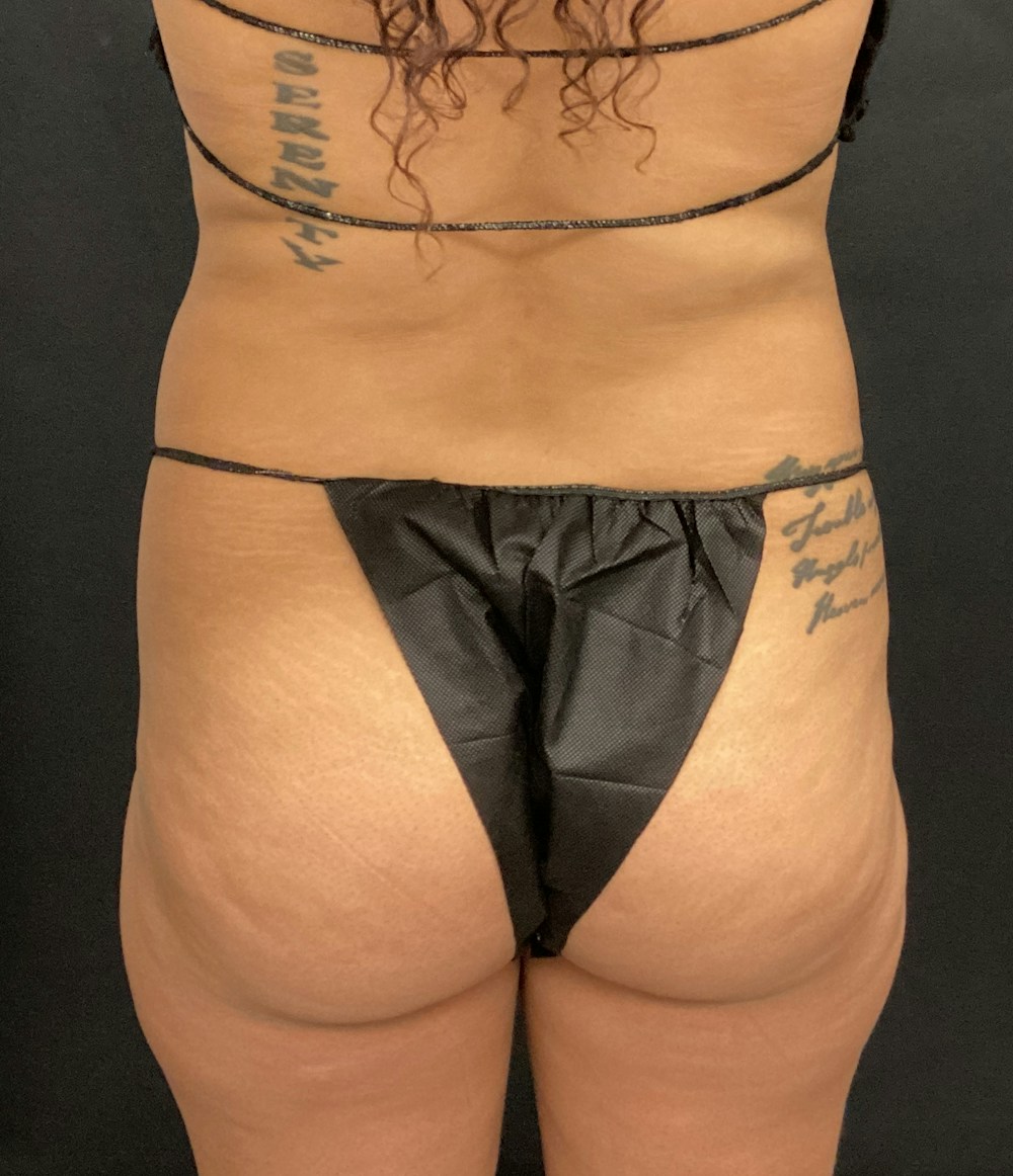 Brazilian Butt Lift Before & After Gallery - Patient 58244194 - Image 1