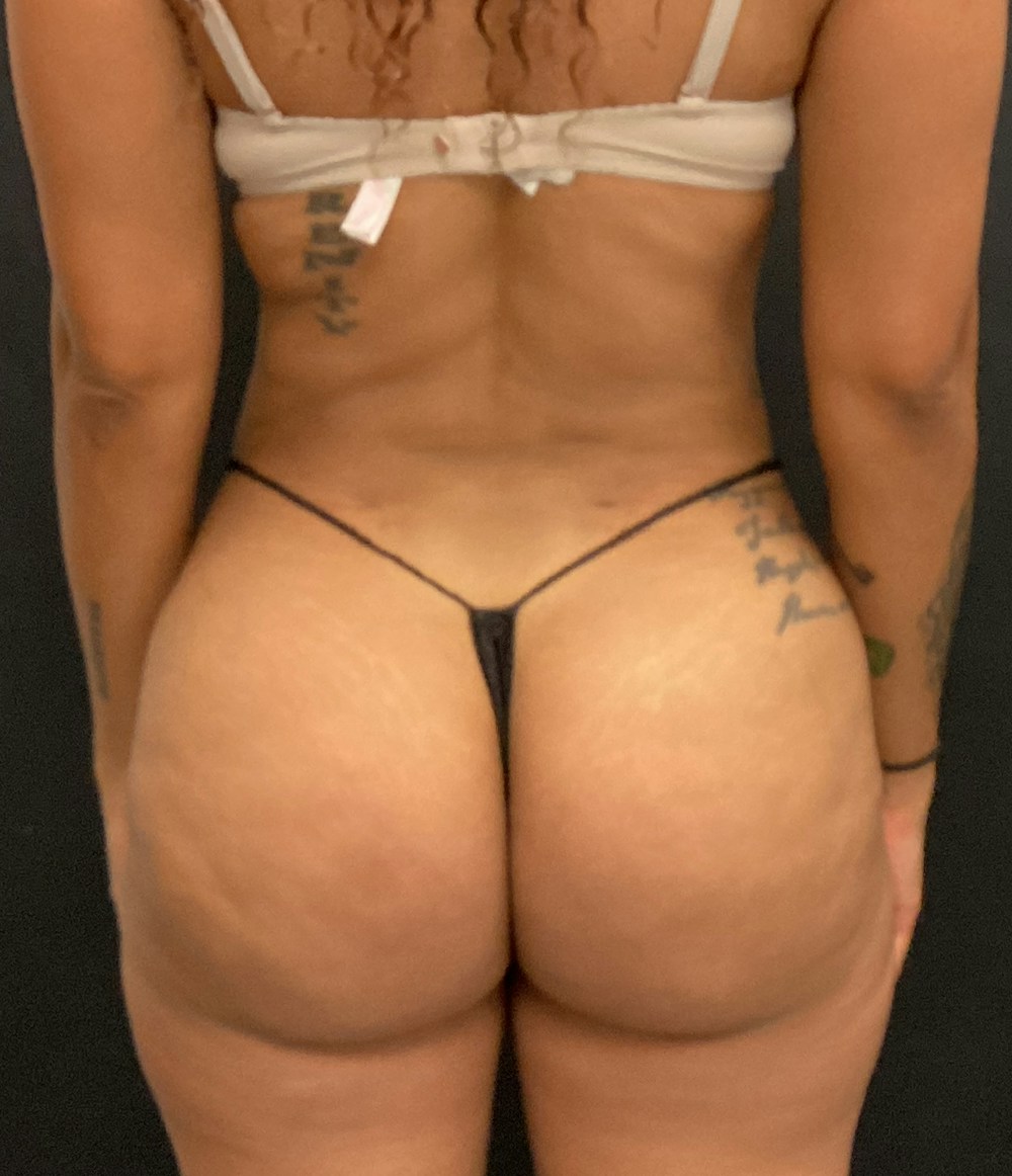 Brazilian Butt Lift Before & After Gallery - Patient 58244194 - Image 2