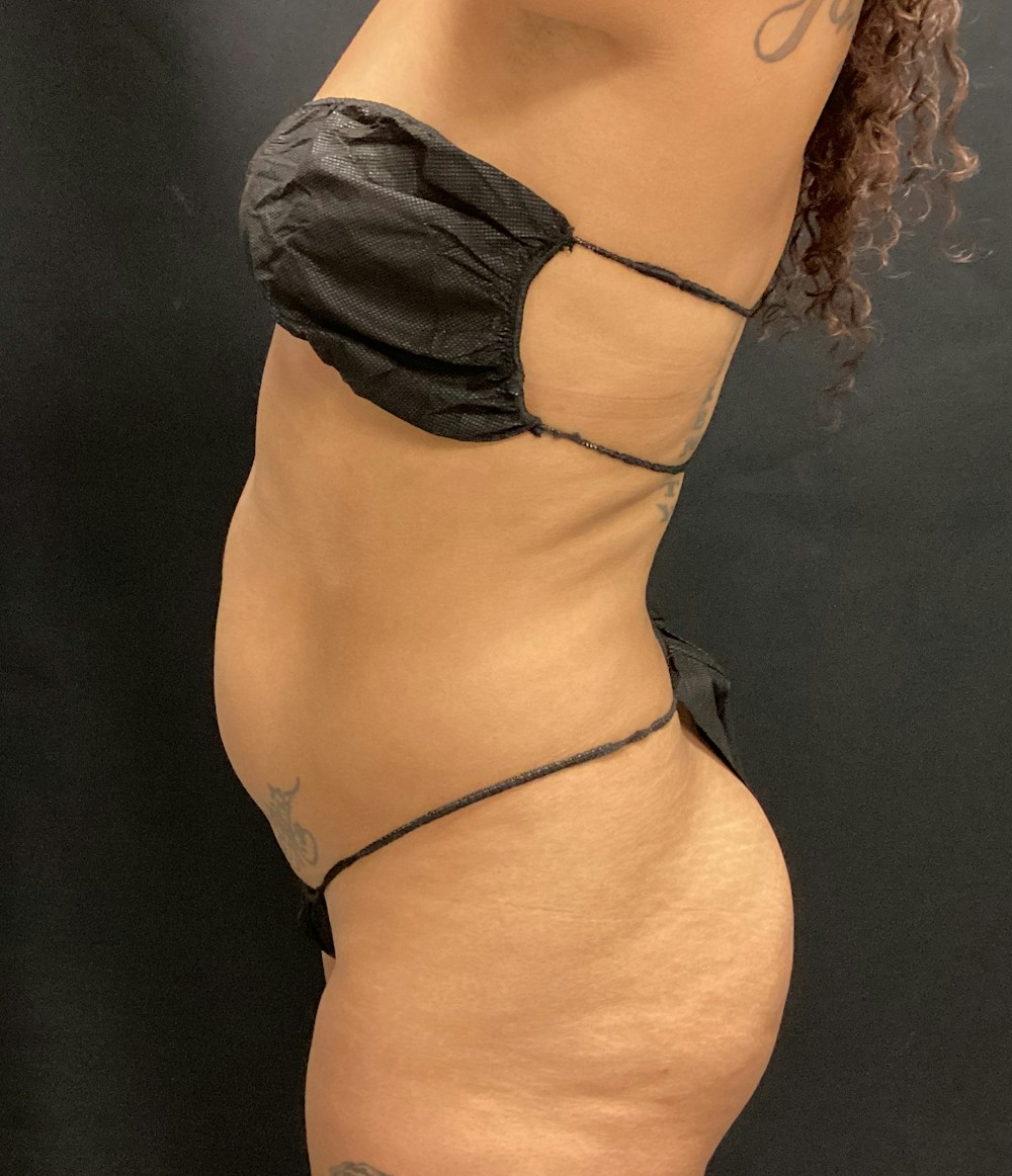 Lipo 360 Before & After Gallery - Patient 89193878 - Image 5