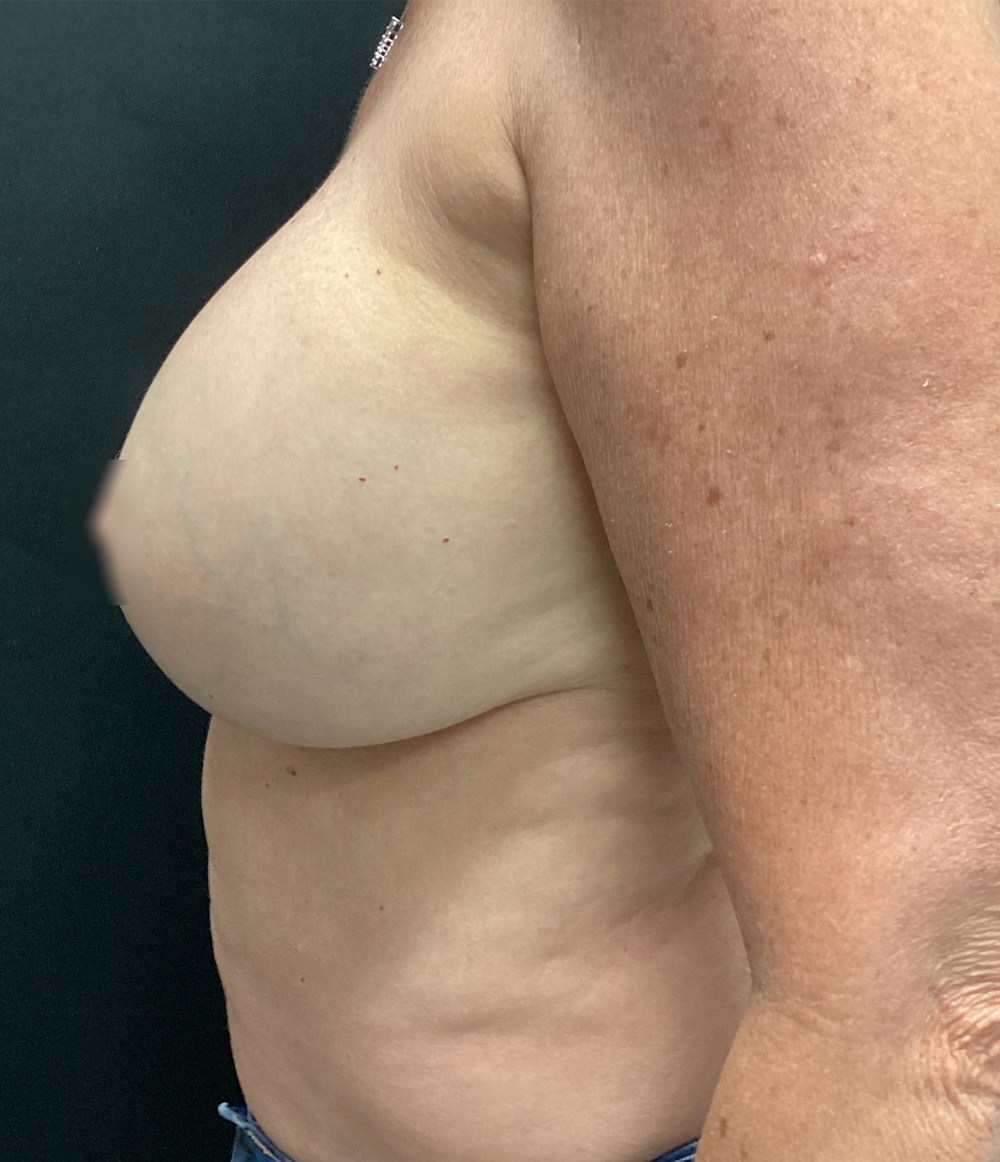 Breast Implant Exchange Before & After Gallery - Patient 58328749 - Image 6