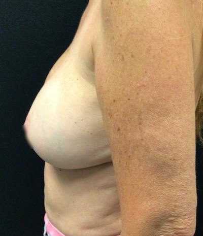 Breast Implant Exchange Before & After Gallery - Patient 58328749 - Image 5