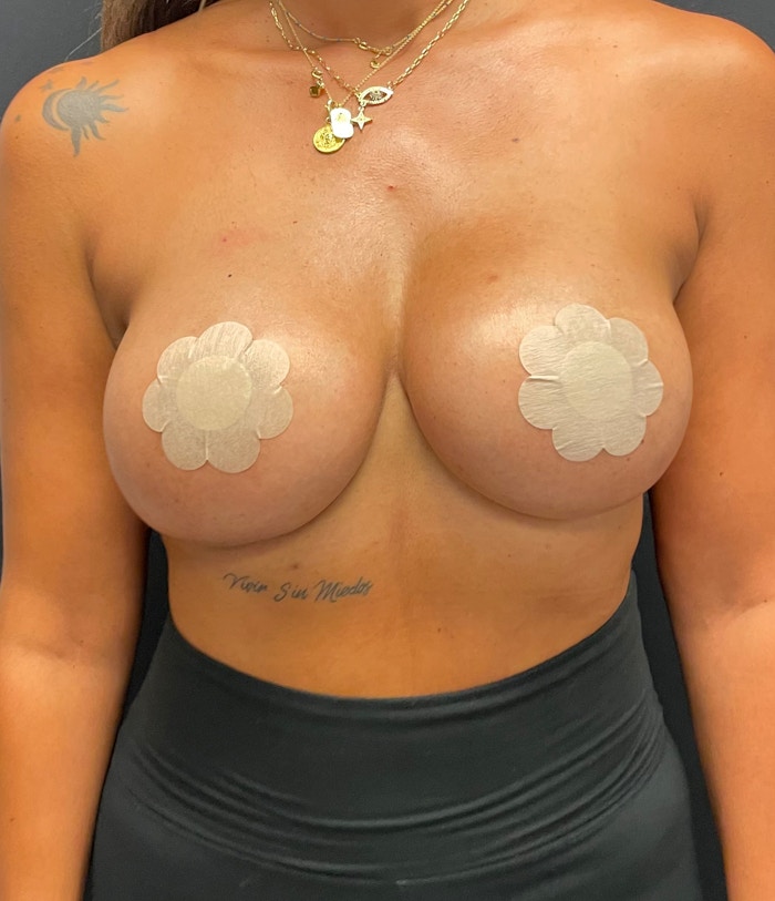 Breast Implant Exchange Before & After Gallery - Patient 58334824 - Image 2