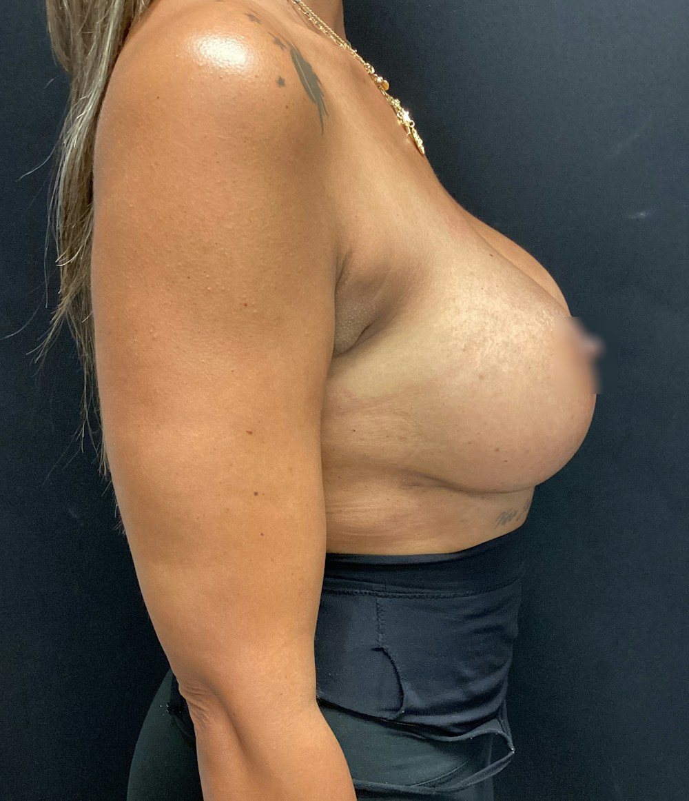Breast Implant Exchange Before & After Gallery - Patient 58334824 - Image 6