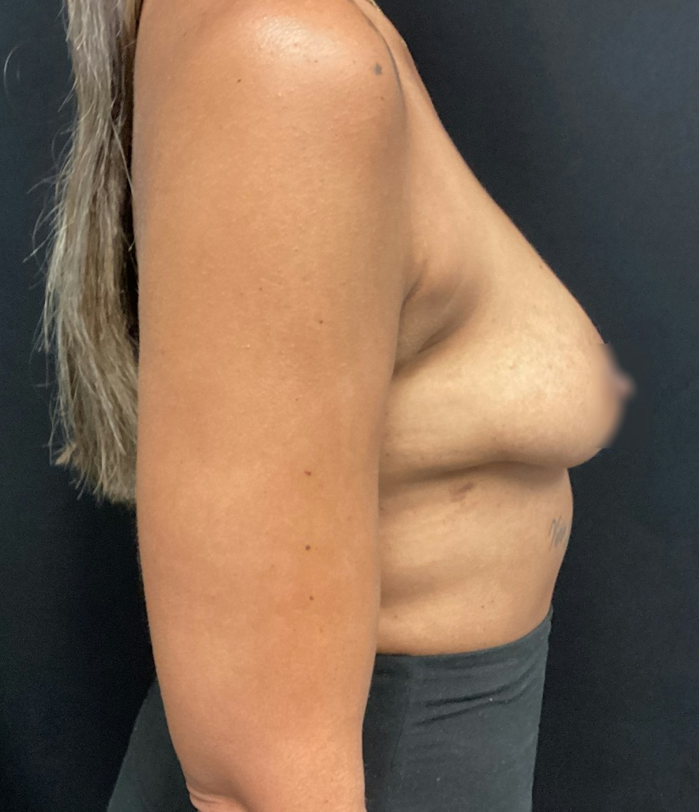 Breast Implant Exchange Before & After Gallery - Patient 58334824 - Image 5