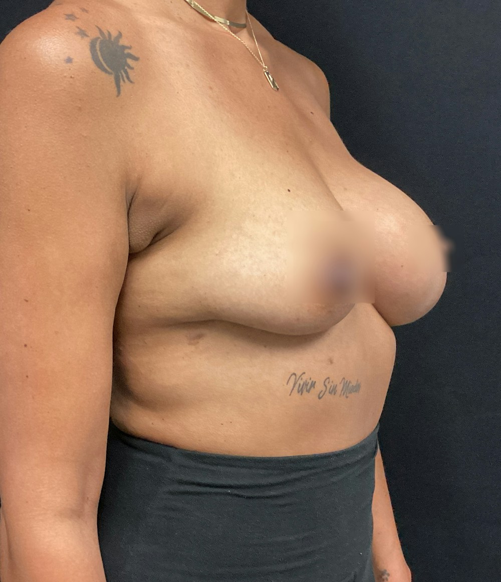 Breast Implant Exchange Before & After Gallery - Patient 58334824 - Image 3