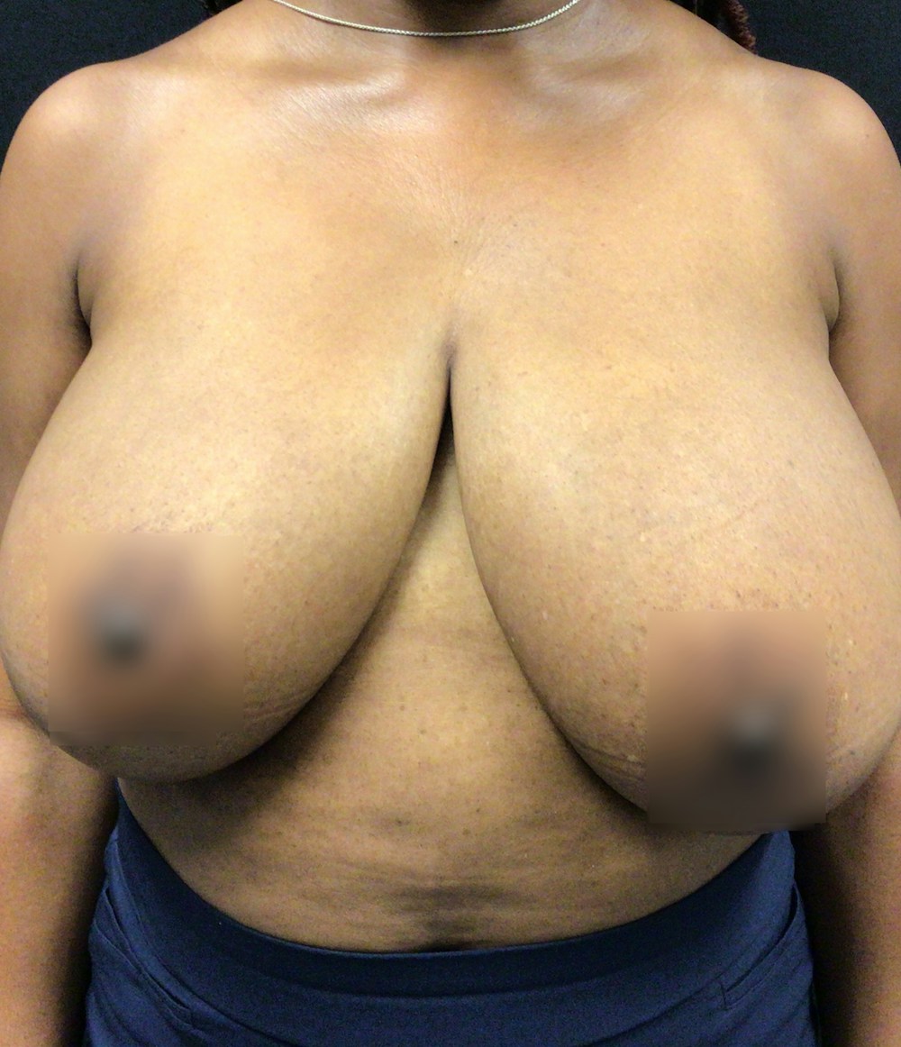 Breast Reduction Before & After Gallery - Patient 58450141 - Image 3