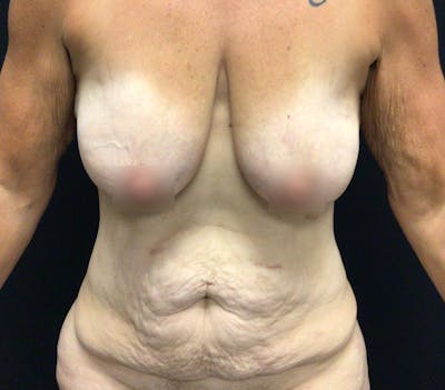 Breast Lift Before & After Gallery - Patient 60736841 - Image 1