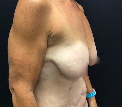 Breast Lift Before & After Gallery - Patient 60736841 - Image 3