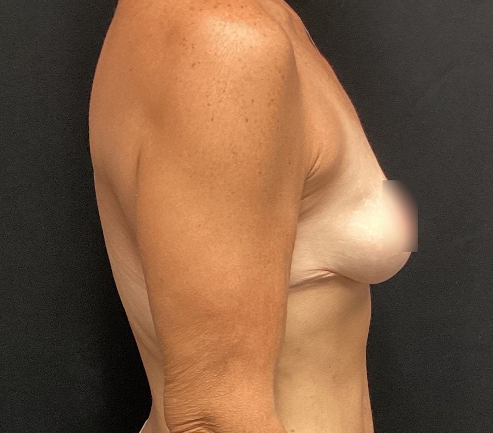 Breast Lift Before & After Gallery - Patient 60736841 - Image 6