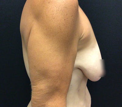 Breast Lift Before & After Gallery - Patient 60736841 - Image 5