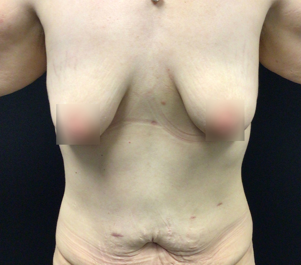 Breast Lift Before & After Gallery - Patient 60736885 - Image 1