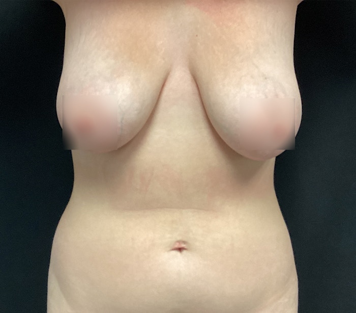 Breast Lift Before & After Gallery - Patient 60736909 - Image 1