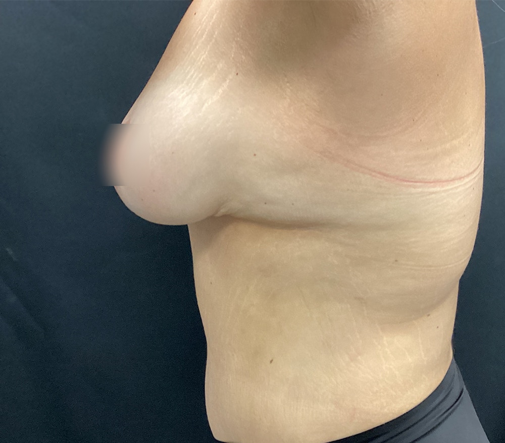 Breast Lift Before & After Gallery - Patient 60747993 - Image 6