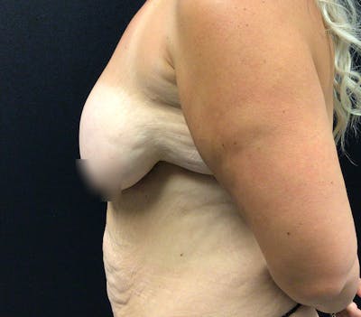 Breast Lift Before & After Gallery - Patient 60747993 - Image 5