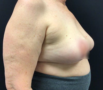 Breast Lift Before & After Gallery - Patient 60748386 - Image 4