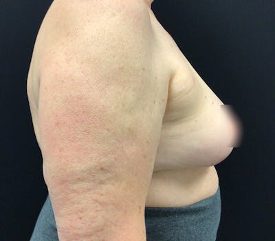 Breast Lift Before & After Gallery - Patient 60748386 - Image 6