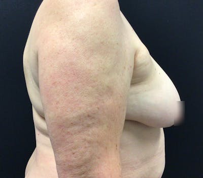 Breast Lift Before & After Gallery - Patient 60748386 - Image 5