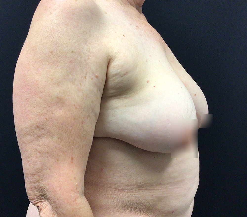 Breast Lift Before & After Gallery - Patient 60748386 - Image 4