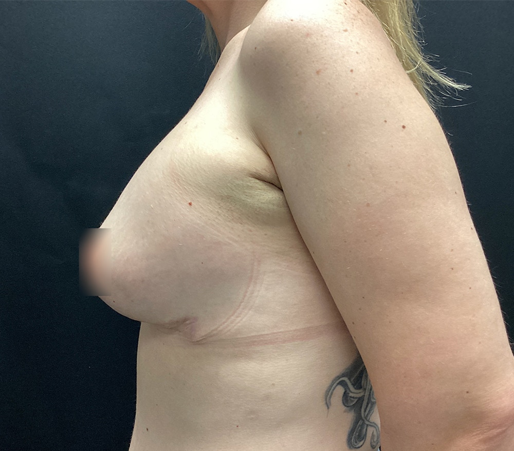 Breast Lift Before & After Gallery - Patient 60748403 - Image 6