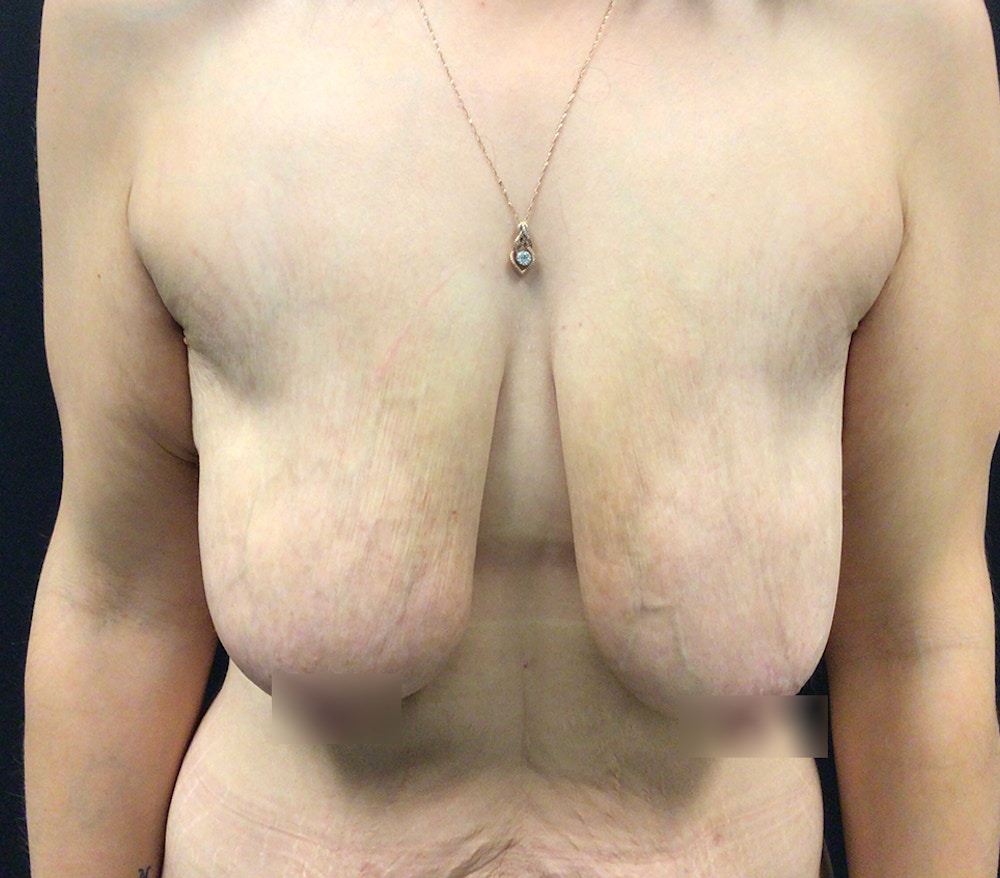 Breast Lift Before & After Gallery - Patient 60748762 - Image 1