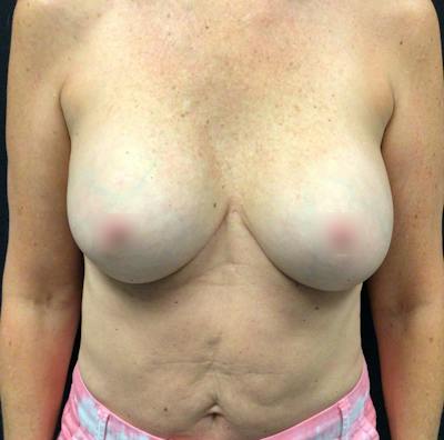 Breast Implant Exchange Before & After Gallery - Patient 58328749 - Image 1