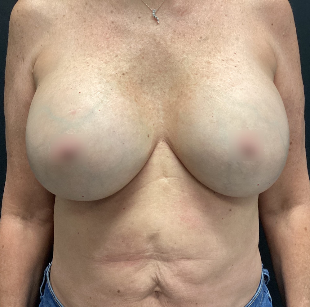Breast Implant Exchange Before & After Gallery - Patient 58328749 - Image 2