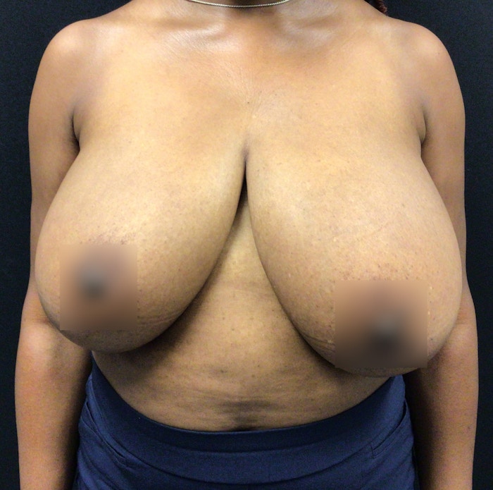 Breast Reduction Before & After Gallery - Patient 58450141 - Image 1