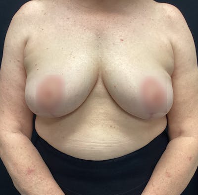Breast Lift Before & After Gallery - Patient 60748386 - Image 2