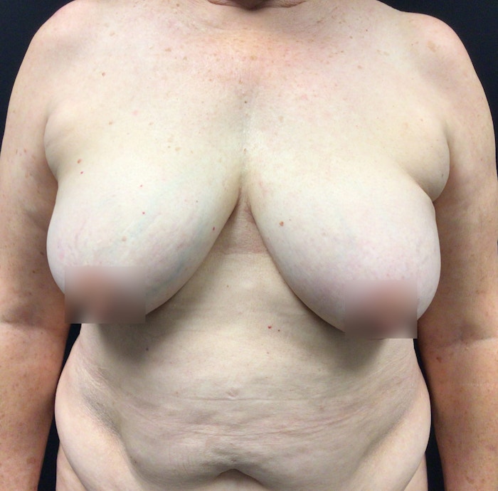 Breast Lift Before & After Gallery - Patient 60748386 - Image 1
