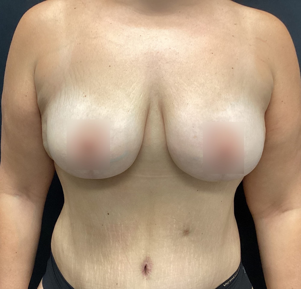 Breast Lift Before & After Gallery - Patient 60747993 - Image 2
