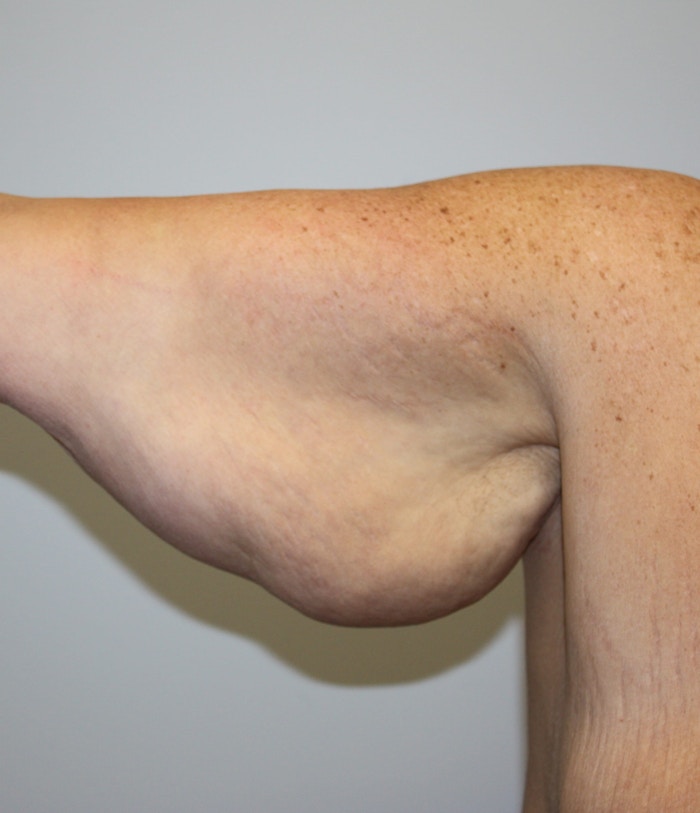Arm Lift Before & After Gallery - Patient 62070233 - Image 1